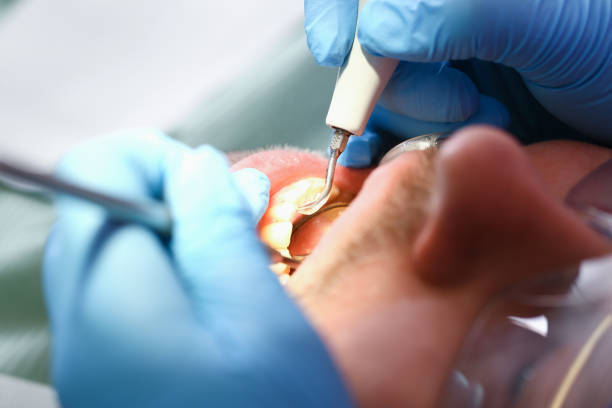 Best Emergency Tooth Extraction in Jacksonville, NC